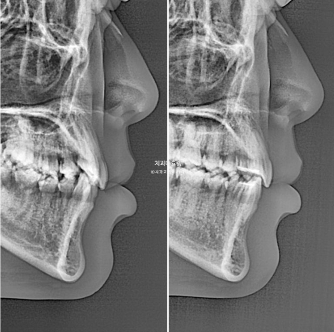 인비절라인 비발치 제2대구치 발치 사랑니 대체 교정 심한 덧니 교정 치료 관련 이미지 27