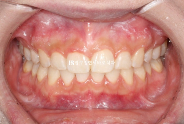 Can't Invisalign Move the Roots? An Actual Case of Extraction Treatment for Protruding Mouth at a Gangnam Orthodontic Clinic image 9