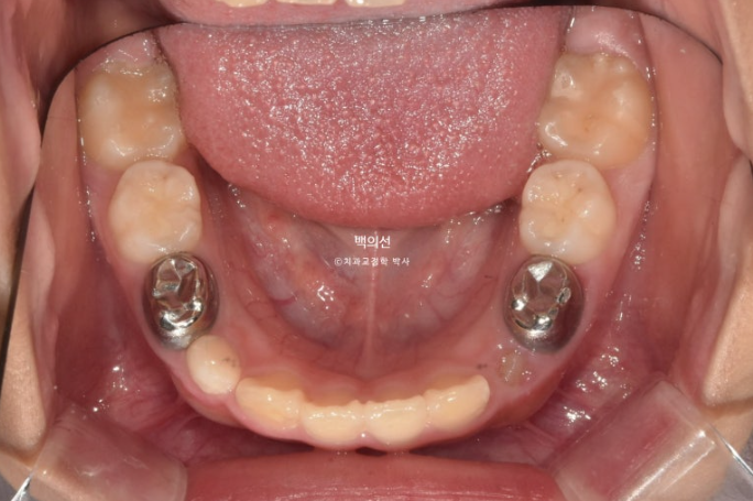 소아 비대칭 교정 인비절라인 퍼스트 재제작 1회 MA 치료 관련 이미지 7