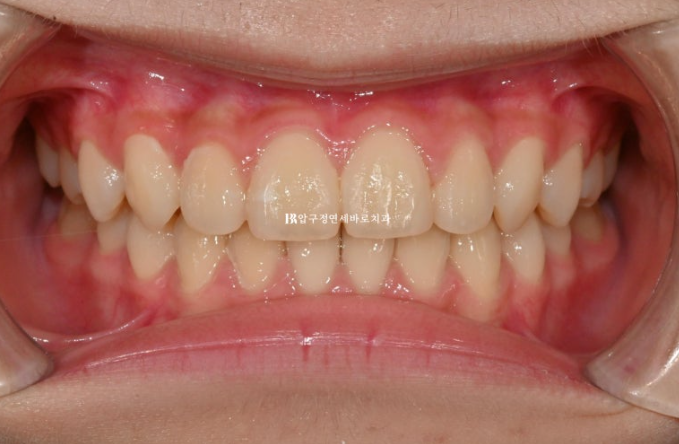 어린이교정 투명교정 인비절라인 퍼스트 후기 관련 이미지 10