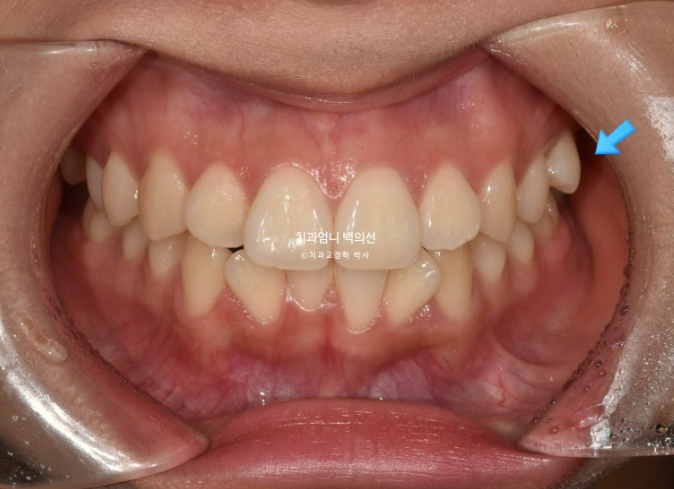 앞니 부분 교정 급속 교정 토끼이빨 MTA 미니튜브 치간삭제 치료기간 9개월 관련 이미지 2