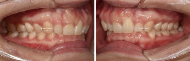 Inward-Tilted Teeth Orthodontic Treatment Review | Actual Case Improved with Non-Extraction Orthodontic Treatment for Gummy Smile, Deep Overbite & Gum Asymmetry — Gangnam Orthodontic Clinic image 3
