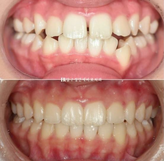 어린이 투명교정 인비절라인 틴 덧니 교정 후기 관련 이미지 1