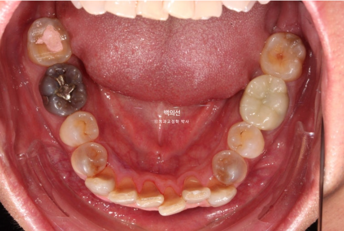 Treatment Review: No-Prep Laminate for Tetracycline-Stained Teeth image 7