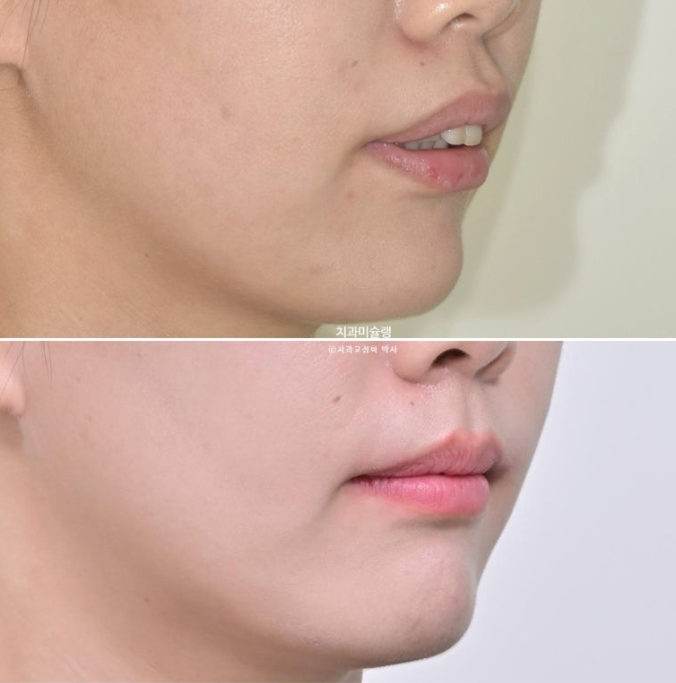 돌출입 덧니 발치 교정 인비절라인 교정 후기 관련 이미지 29