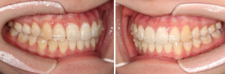 인비절라인 비발치 토끼이빨 교정 덧니 교정 치료기간 1년 8개월 관련 이미지 7