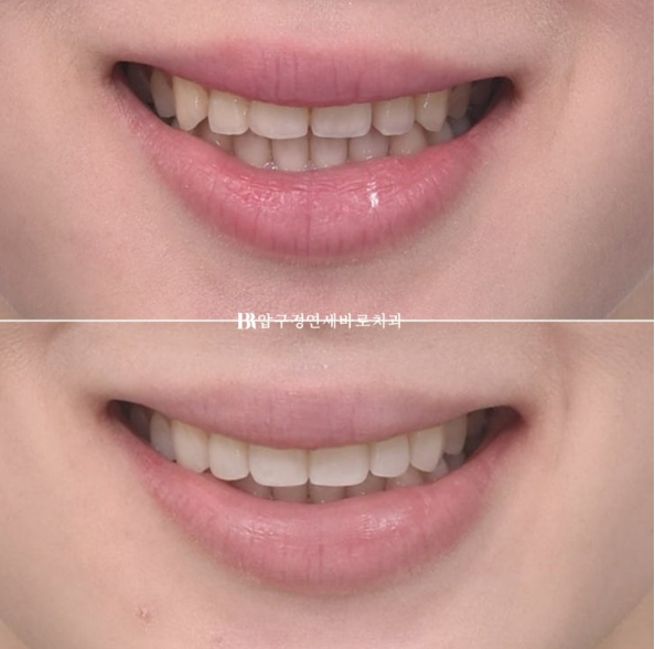 How to Create a Beautiful Smile Line? | A Real Case of Changing a Smile with No-Prep Laminates image 12