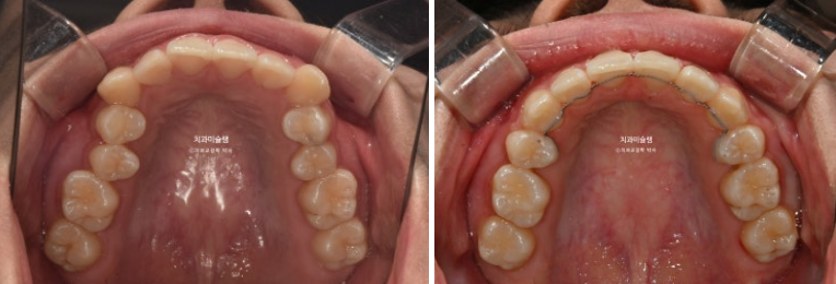 잇몸미소 거미스마일 치료 옥니 교정 잇몸성형 후기 관련 이미지 15