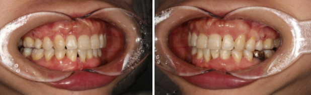 40대 치아교정 가능할까요? 치주염 있어도 치아교정 가능할까요? 임플란트 없이 교정하기 관련 이미지 9