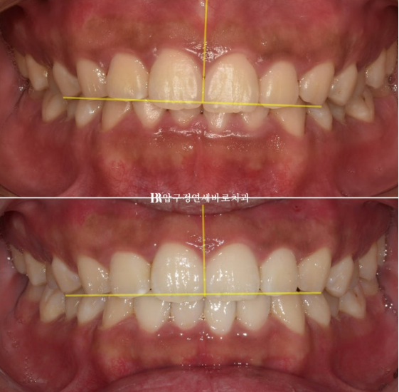 Can Invisalign Lite Correct Deep Bite and the Occlusal Plane? | A Real Case With 14 Aligners Over 4 Months image 10