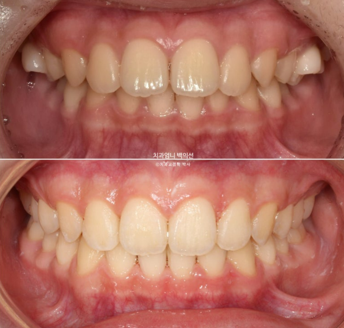 어린이 투명교정 인비절라인 퍼스트 가위교합 돌출교정 덧니교정 관련 이미지 1