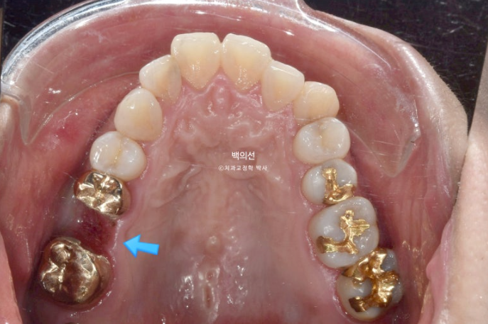 거미스마일 교정 돌출입 발치교정 입술부전 호두턱 치료기간 2년반 관련 이미지 10