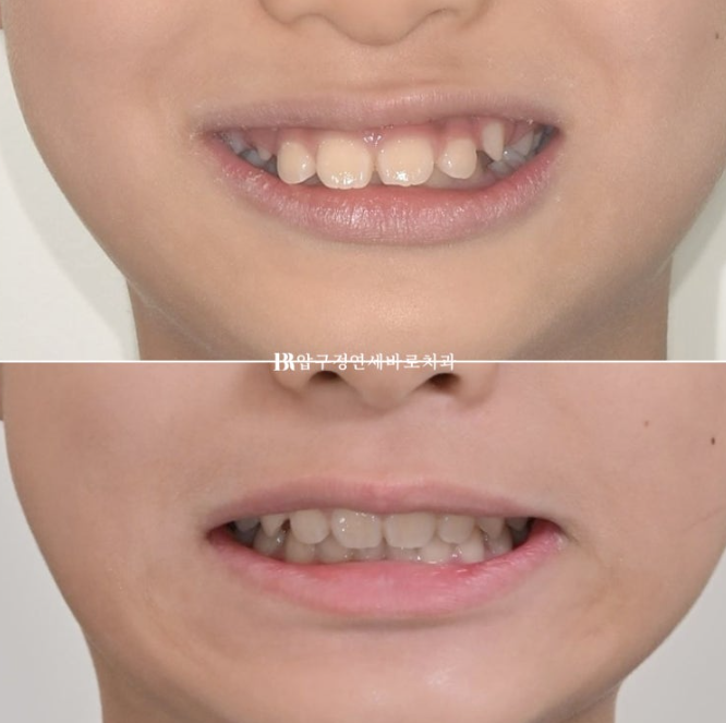 Pediatric Clear Aligners That Improved Both Deep Bite and Protruding Teeth image 18