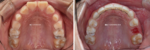 압구정 어린이교정 인비절라인 퍼스트 악궁확장 덧니 교정 관련 이미지 9