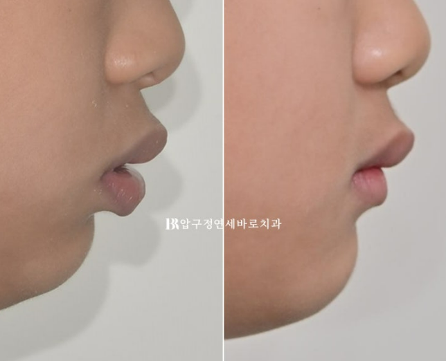 어린이 교정, 인비절라인 퍼스트로 영구치 교정까지 한 번에 관련 이미지 21