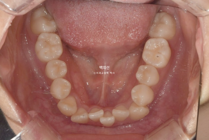 덧니 발치교정 클리피씨 입매 부작용 인중 입술 잇몸 퇴축 관련 이미지 6