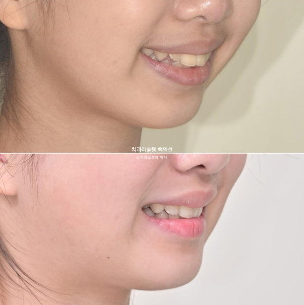 돌출입 무턱 인비절라인 발치교정 덧니 치료기간 1년 11개월 관련 이미지 17