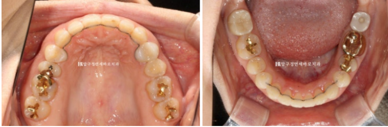 인비절라인 캔팅 교정 과개교합 교정 임플란트 재교정 관련 이미지 11