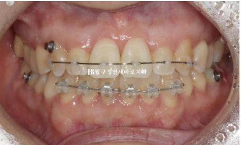 토끼이빨 치아교정 ? 토끼이빨 교정 치료기간은 어떻게 되나요? 관련 이미지 4