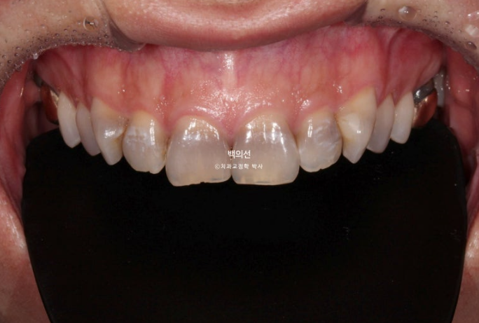 Treatment Review: No-Prep Laminate for Tetracycline-Stained Teeth image 3