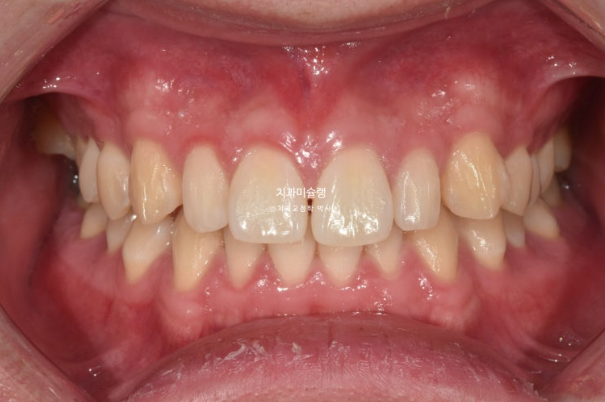 비대칭 비발치 거미스마일 잇몸미소 중심선 가위교합치료 무삭제 라미네이트 관련 이미지 2
