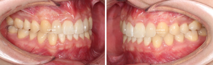 비대칭 비발치 거미스마일 잇몸미소 중심선 가위교합치료 무삭제 라미네이트 관련 이미지 21