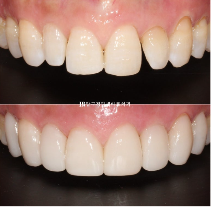 Can It Be Done in Your 50s? Real Results from Limited Front Teeth Orthodontics + No-Prep Laminate Veneers Revealed image 12