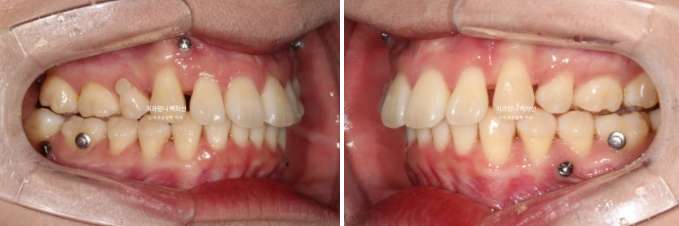 돌출입 교정 인비절라인 발치 교정 후기 관련 이미지 10