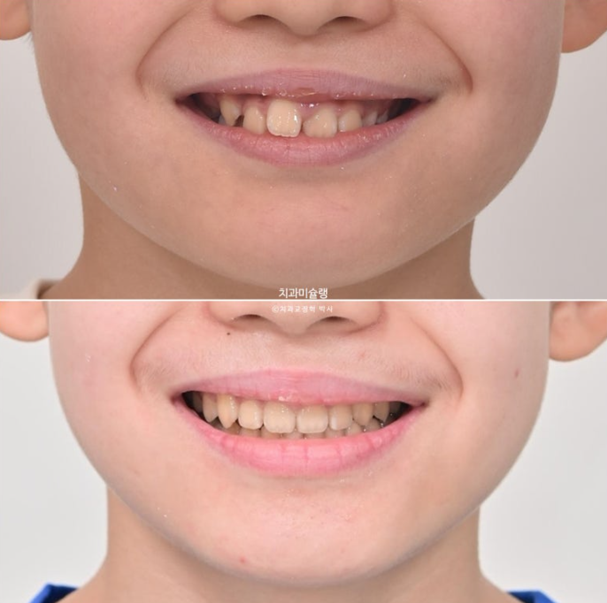 선천적 결손 잔존유치 과개교합 돌출입 인비절라인 퍼스트 어린이 투명교정 치료기간 관련 이미지 23