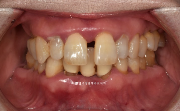 60대 치아교정 가능할까요? 치주염이 있는 경우 앞니 부분교정 6개월 치료 후기 관련 이미지 2