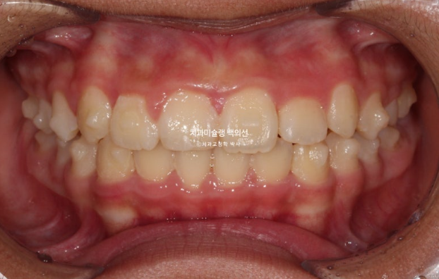 덧니 반대교합 과개교합 인비절라인 퍼스트 악궁확장 어린이 교정 관련 이미지 5