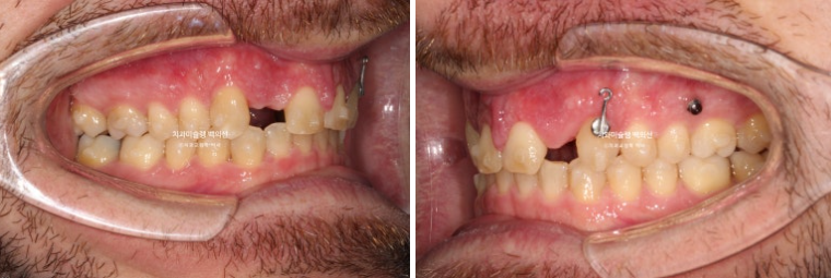 앞니 선천적 결손 인비절라인 임플란트 과개교합 치료 기간 관련 이미지 12