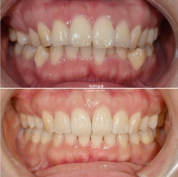 돌출입 덧니 발치 교정 인비절라인 교정 후기 관련 이미지 24