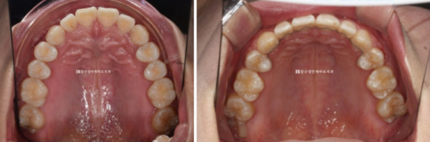 A Review of Extraction Orthodontic Treatment for Protruding Mouth | The Details of Orthodontics That Transform Buccal Corridors and Smile Lines image 10