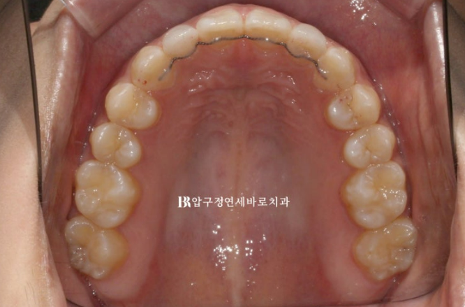 인비절라인 + 무삭제 라미네이트로 왜소치 치료하기 관련 이미지 9