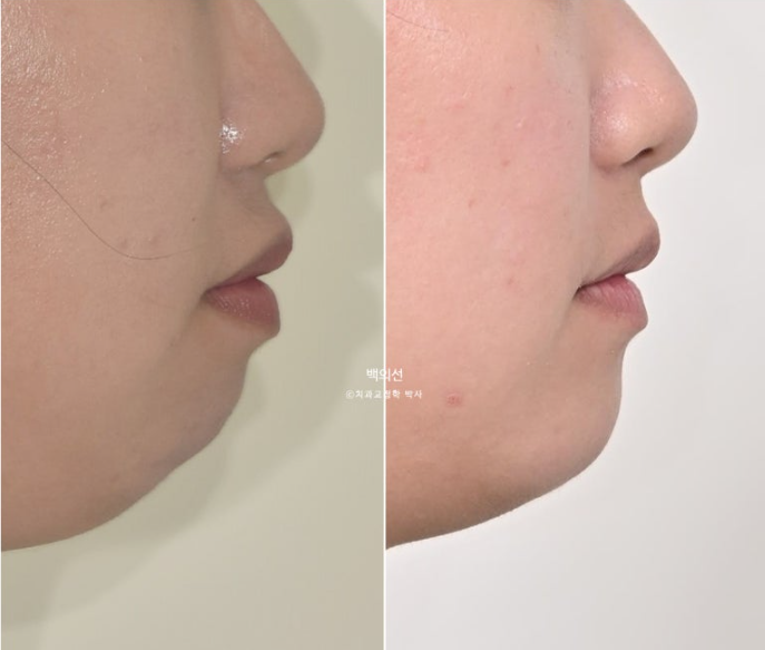 30대 치아교정 돌출입 교정 :: 잇몸미소 거미스마일 교정 입술부전증 결손치 무턱교정 관련 이미지 1