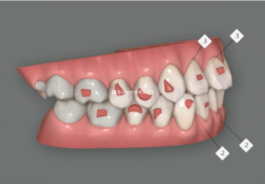 인비절라인 익스프레스 토끼이빨 앞니교정 ? 관련 이미지 5