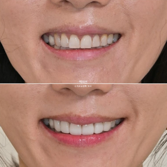 40대 무삭제 라미네이트 블랙트라이앵글 레진 치료 관련 이미지 1