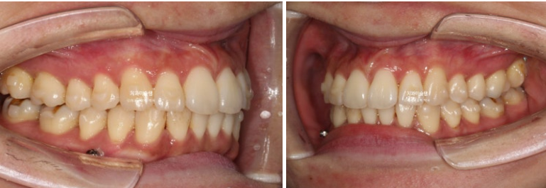 비발치 돌출입 인비절라인 교정 가위교합 중심선 맞추기 관련 이미지 9