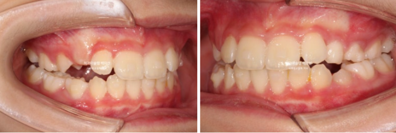 어린이 무턱 성장교정 덧니 인비절라인 퍼스트 악궁확장 치료기간 2년 관련 이미지 19