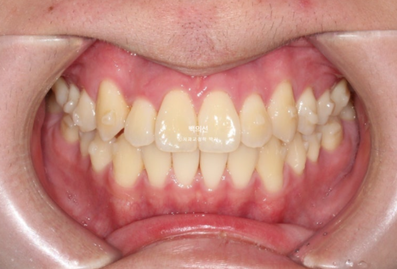 유학생 교정 덧니 반대교합 인비절라인 라이트 치료기간 관련 이미지 7