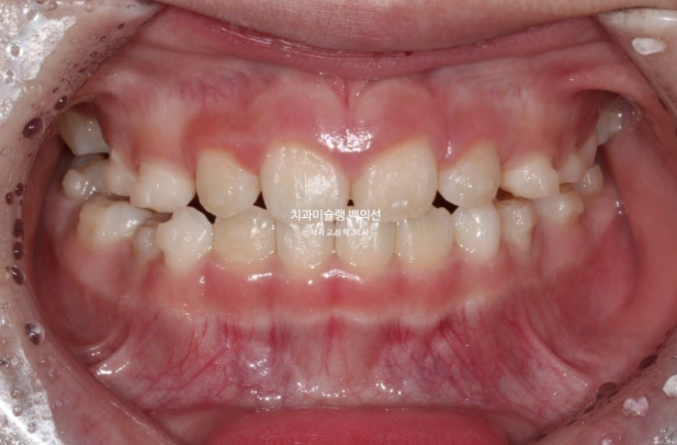 어린이 비대칭 반대교합 주걱턱 인비절라인 퍼스트 프리올소 성장 교정 관련 이미지 13