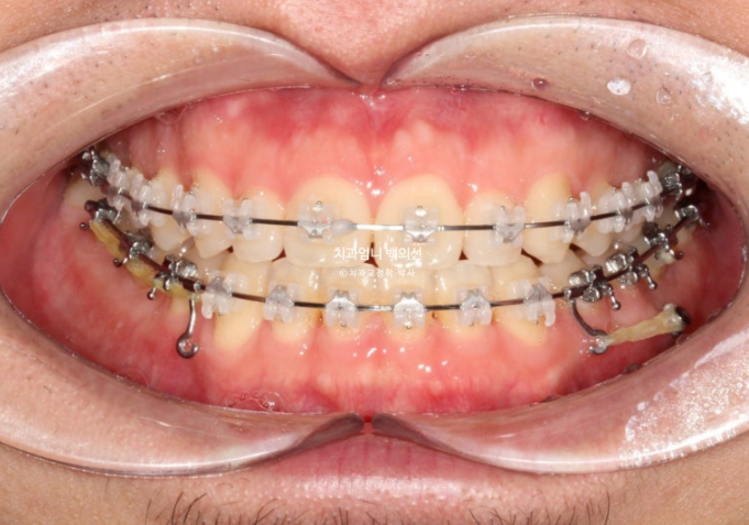 주걱턱 교정 반대교합 소구치 선천적 결손 부정교합 비발치 교정 후기 관련 이미지 7