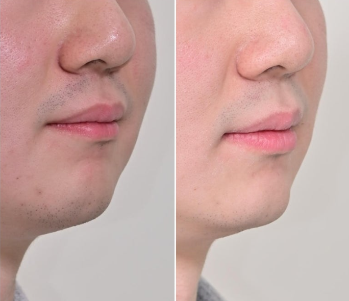 인비절라인 라이트 돌출 과개교합 중심선 교정 치간삭제 치료기간 관련 이미지 15