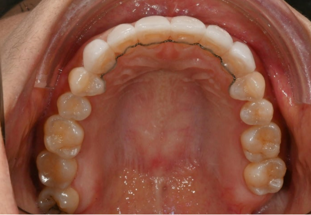 벌어진 치아 교정 인비절라인 라이트 무삭제 라미네이트 치료 관련 이미지 20