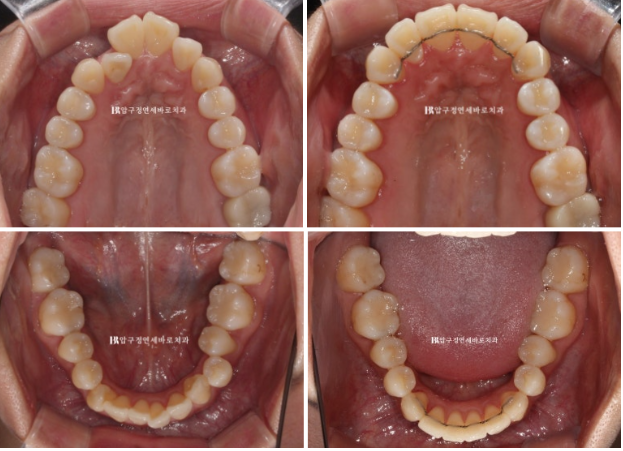 예비신부 교정 단기 앞니 부분교정 치료기간 6개월 관련 이미지 14