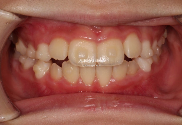 어린이 무턱 성장교정 덧니 인비절라인 퍼스트 악궁확장 치료기간 2년 관련 이미지 10