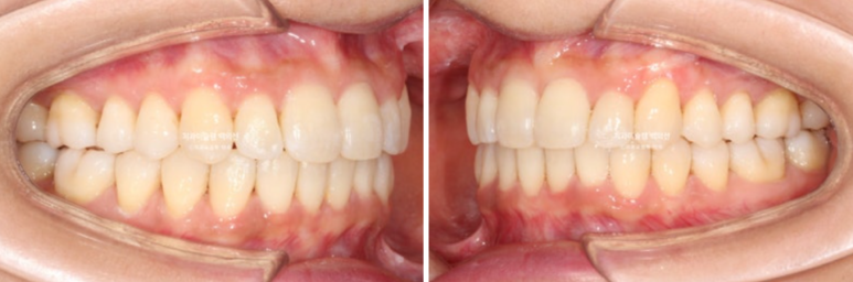 옥니 덧니 과개교합 반대교합 중심선 인비절라인 치료기간 1년 관련 이미지 12