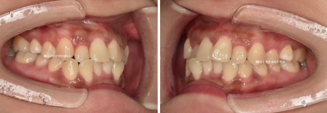 Is compliance important for Invisalign? | A real case that improved reverse bite and scissors bite in 8 months image 3