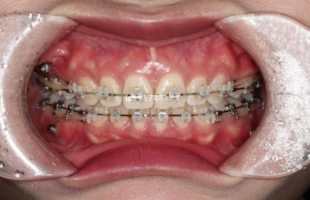 A Review of Extraction Orthodontic Treatment for Protruding Mouth | The Details of Orthodontics That Transform Buccal Corridors and Smile Lines image 6